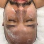 Acne Facial