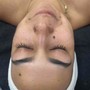 Acne Facial