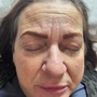 Facial Cupping Therapy