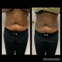 60 Min Body Contour(Non-invasive Lipo)