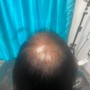 Scalp Treatment