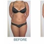 Lipo laser fat loss