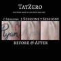 Tattoo Removal