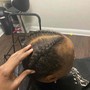 Scalp Treatment