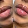 .5 Hyaluronic Needless Lip Filler