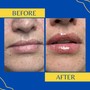 Hyaluronic Needless Lip Filler touch up