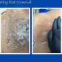 Dermaplaning