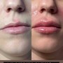 .5 Hyaluronic Needless Lip Filler