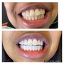 Teeth Whitening