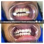 Teeth Whitening