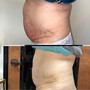 Cryo fat freezing and reduction