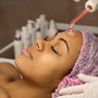 Microneedling Face