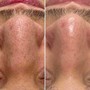 Acne Boot Camp (3-4) months series