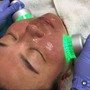 Microneedling Face