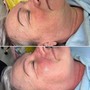 Microneedling Face