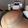 Back leg reduction with cellulite reduction