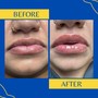 .5 Hyaluronic Needless Lip Filler