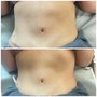 45 min skin tightening treatment with red light therapy