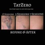 Tattoo Removal