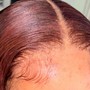 Scalp Treatment