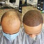 Scalp Micropigmentation