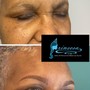 Permanent makeup Removal