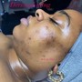 Microdermabrasion