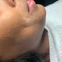 Dermaplaning