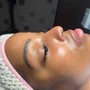 Dermaplaning