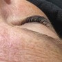 Microdermabrasion