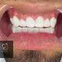 Veneer Repair