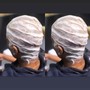 Hair Restoration Treatment