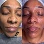 MicroNeedling (series of 4)