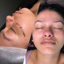 Microdermabrasion