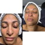 MicroNeedling (series of 4)