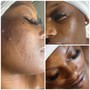 Hyperpigmentation Treatments