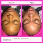 Back Facial Treatment