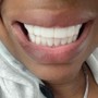 2 Year Coverage Sparkling Halo Veneers in-house Insurance (maintenance/ chips/ broken or missing veneers)