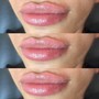 Needles Lip Filler