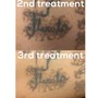 Laser Tattoo Removal On Small Area 5cmx10cm