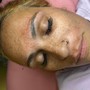 Facial Dermaplaning