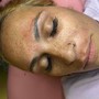 Acne Facial