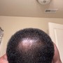 Scalp Treatment