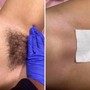 Microdermabrasion Facial