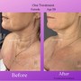 Microneedling Chest