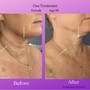 Microneedling Chest