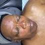 Acne Facial