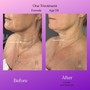 Microneedling Chest