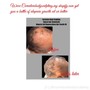 Alopecia hair loss braids