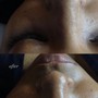 Dermaplaning Facial